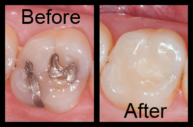 tooth colored filling